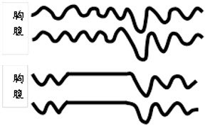 圖1 :  (上)阻塞性睡眠呼吸中止；（下）中樞性睡眠呼吸中止