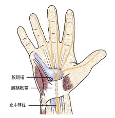 图1 : 腕隧道症候群示意图[1-4]