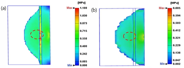 圖2 : Von Mises應力分佈 (a)白斑嚴重組別 (b)白斑輕微組別